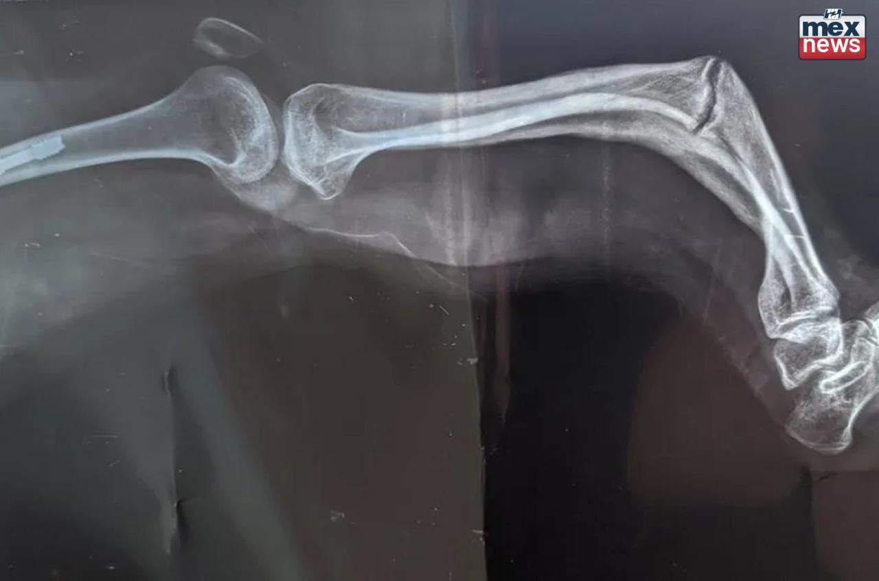 Paraná pode instituir Dia da Osteogênese Imperfeita